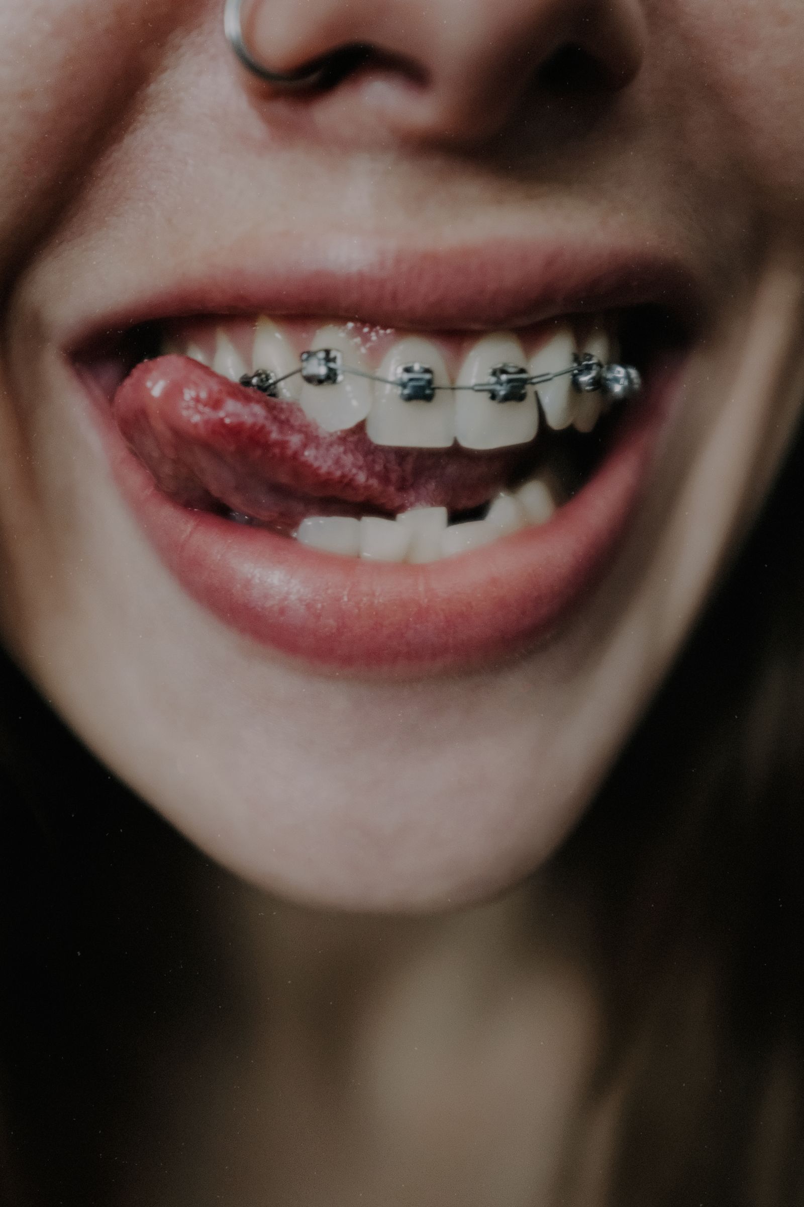 Patient smiling with dental braces in Dubai