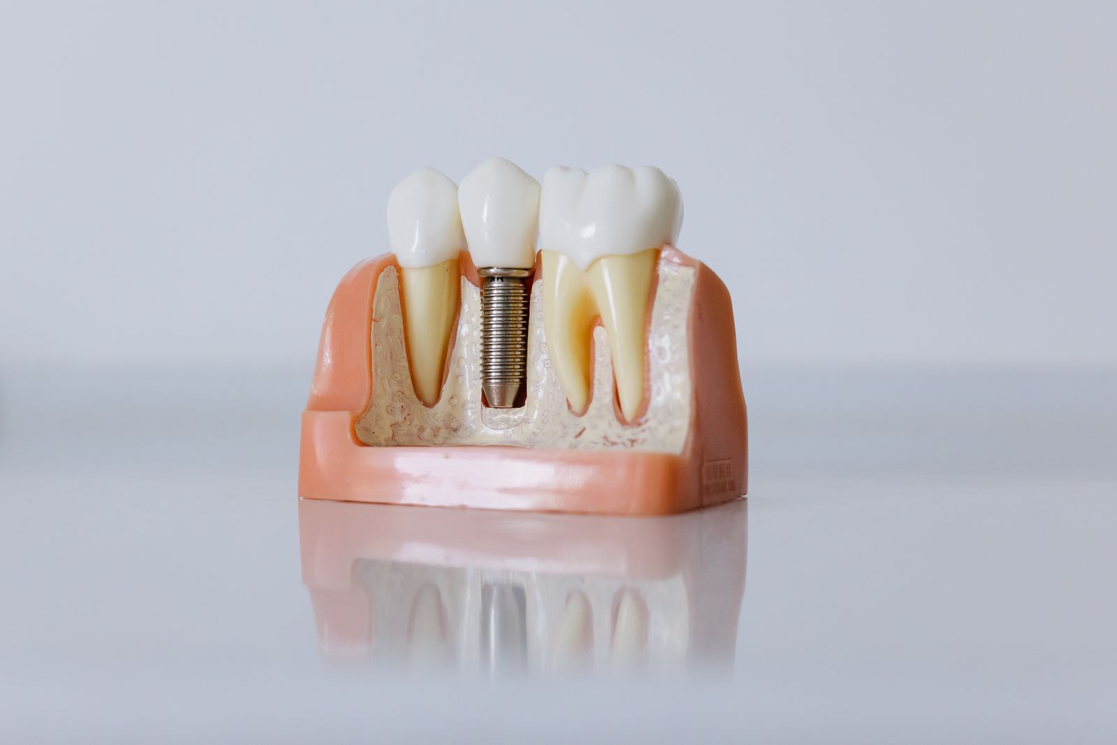 Dental implant model showing titanium implant structure