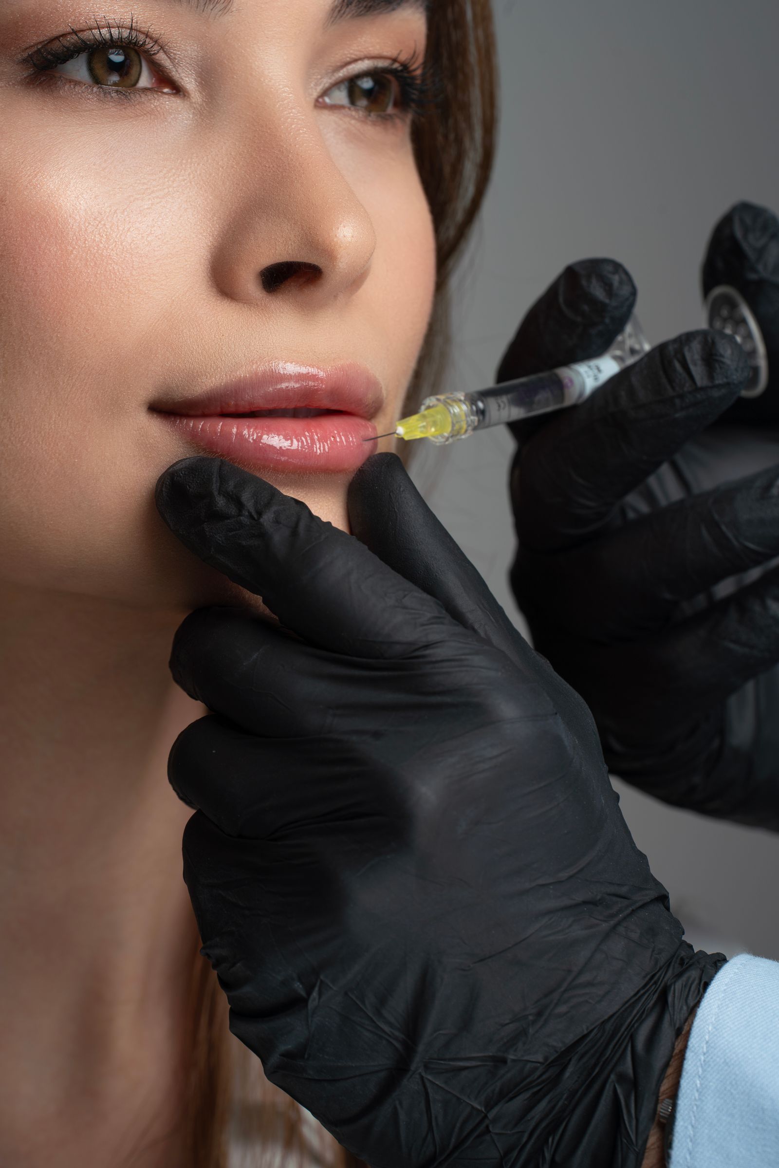 Dermal filler lip injection by aesthetic professional Dubai